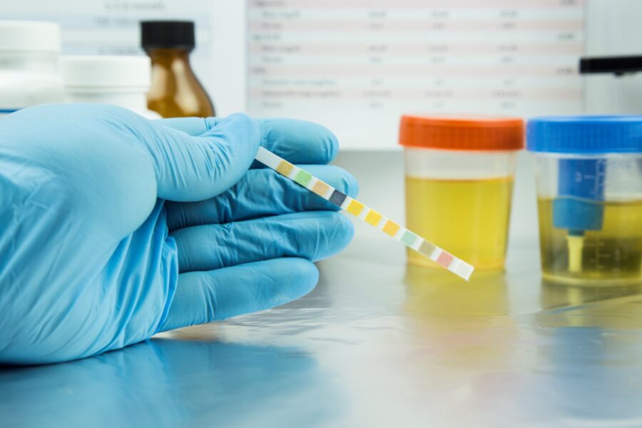gloved hand with test strip and urine samples